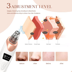 5-in-1 Acne & Blackhead Remover